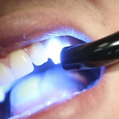 Clareamento dental a laser