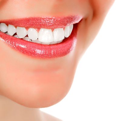 Clareamento dental misto