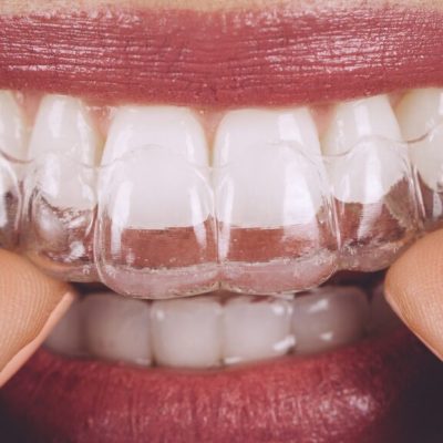 alinhadores invisíveis