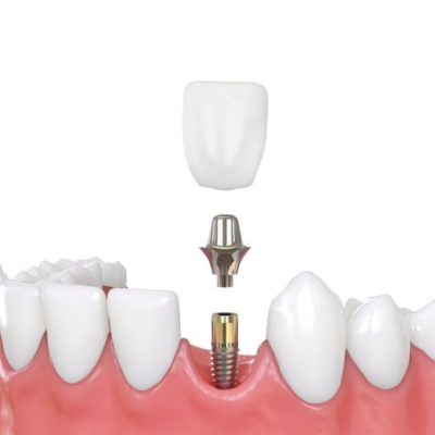 implante-unitario-straumann-50kb-1261x831-1-768x506