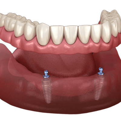 overdenture (1)